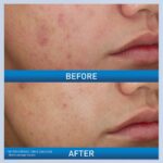 ACNE2