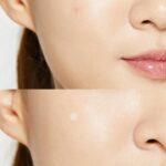 PIMPLE PATCH12
